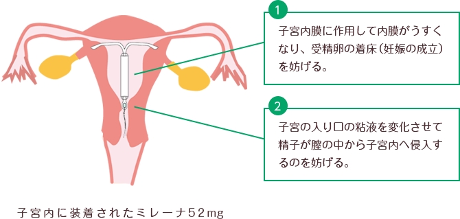 子宮内黄体ホルモン放出システム（IUS・ミレーナ）の仕組み